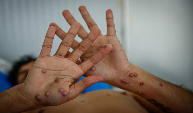 Activan en Colombia un cerco epidemiológico tras confirmar el primer caso de viruela del mono