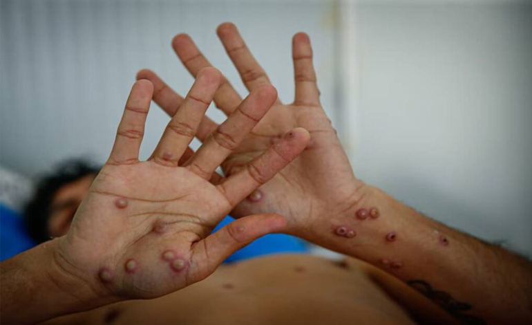 Activan en Colombia un cerco epidemiológico tras confirmar el primer caso de viruela del mono